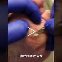 The real pain of calluses It's not just the callus, but the lack of a fat pad