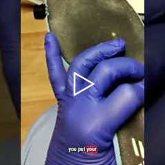 How to prevent calluses and corns from returning