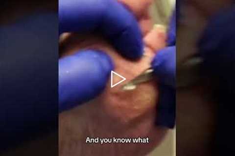 The real pain of calluses It's not just the callus, but the lack of a fat pad