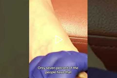 The Stroke That Leaves You Awake But Unable to Move
