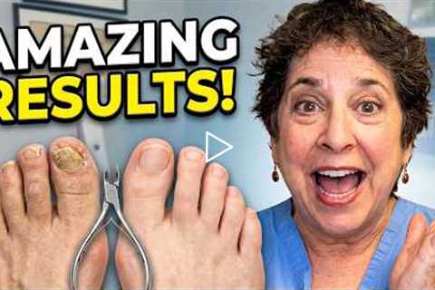 FEET-ure Friday | She Waited 2 YEARS... Look at the Difference! 😲🦶 Thick Toenail Transformation
