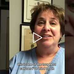 What Happens When You Don't Treat Your Callus #footpain #podiatry #callusremoval