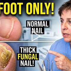 Why Is It Only On One Foot? Thickened Nail Treatment