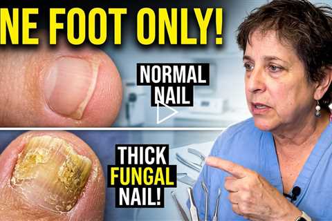 Why Is It Only On One Foot? Thickened Nail Treatment