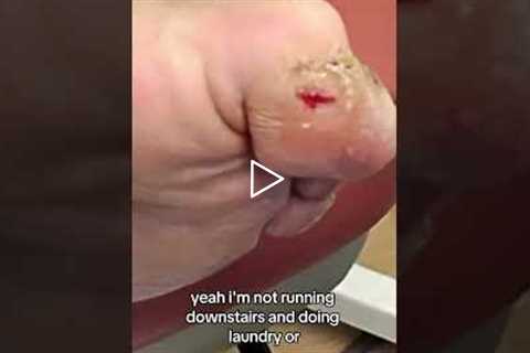 The Reason She Can't Use Her Knee Scooter